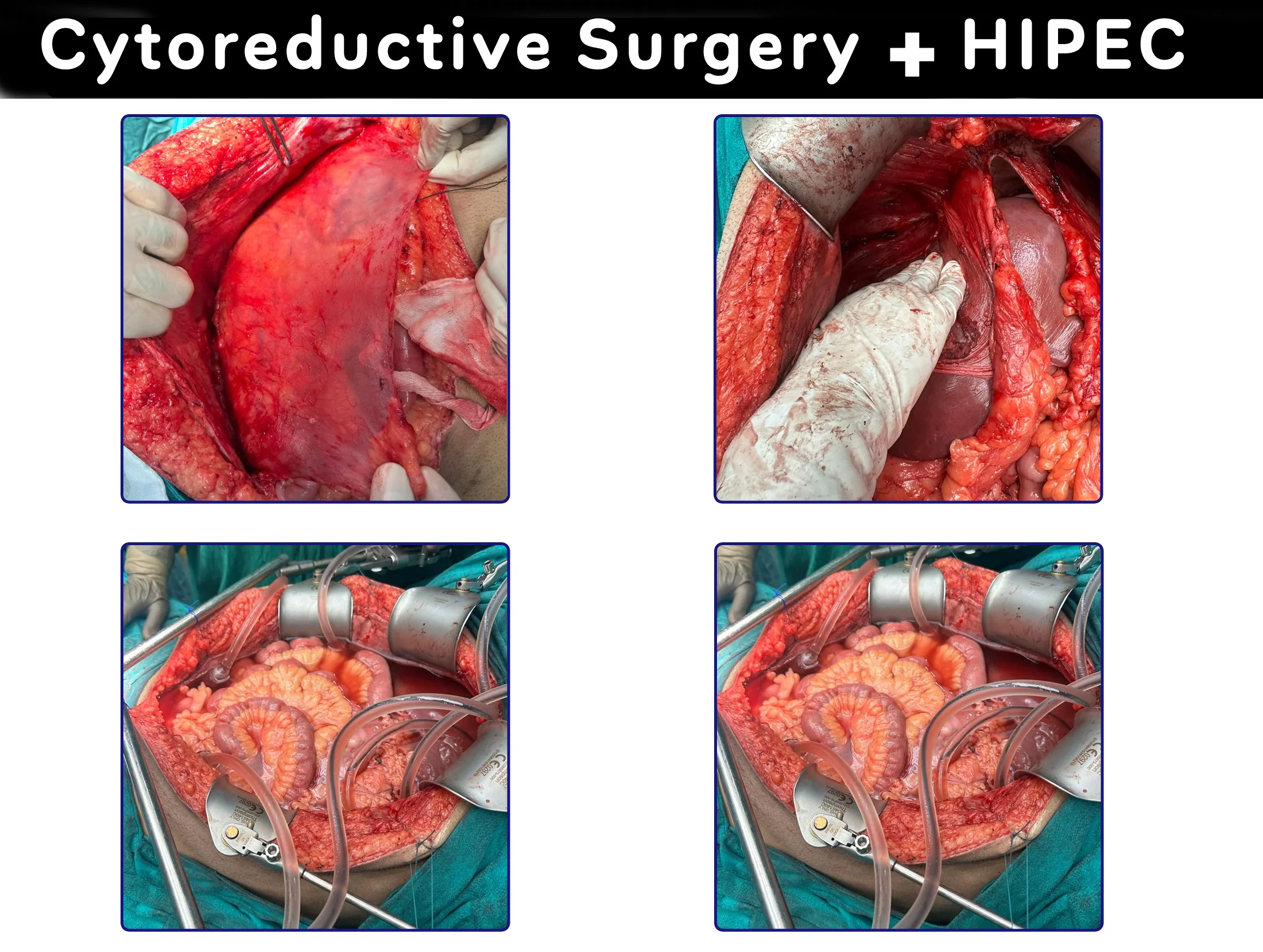 Cytoreductive surgery + HIPEC