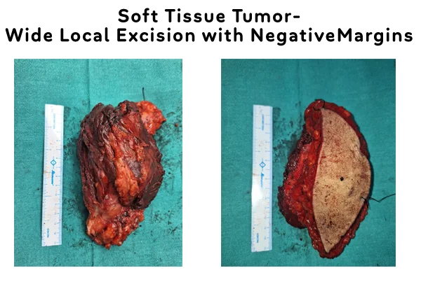Cancer Treatment