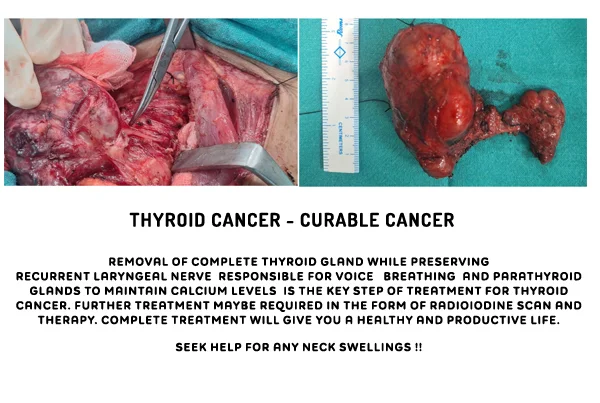 Cancer Treatment
