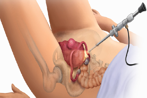 Laparoscopic Uterine Cancer Surgery