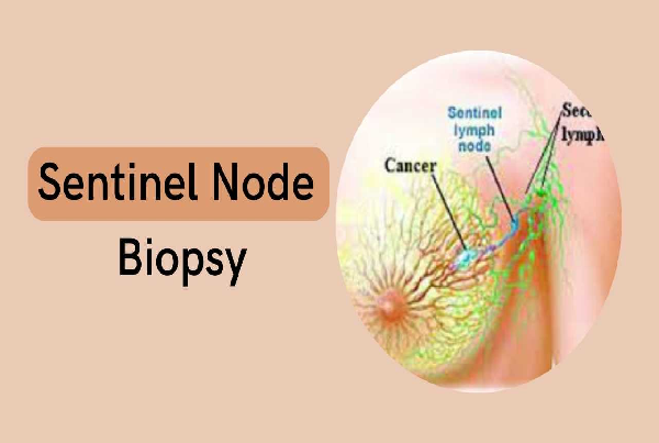 Sentinel Lymph Node Biopsy