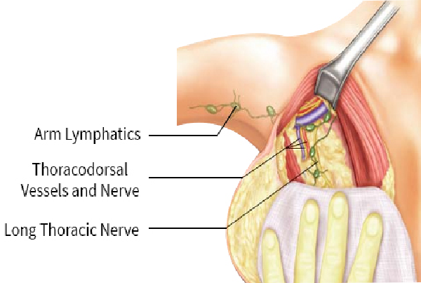 Axillary lymph Node Dissection