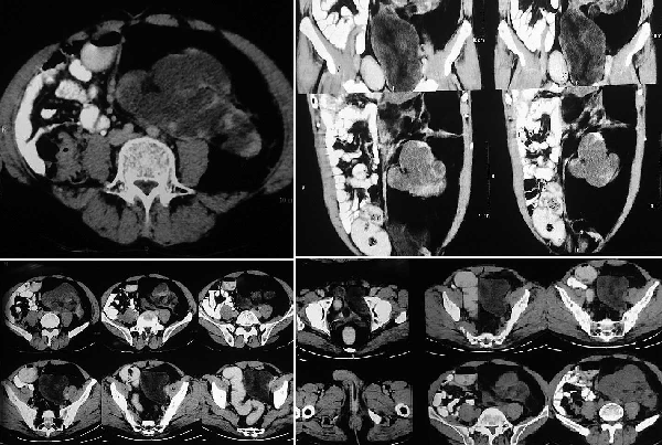 Retro Peritoneal Tumors