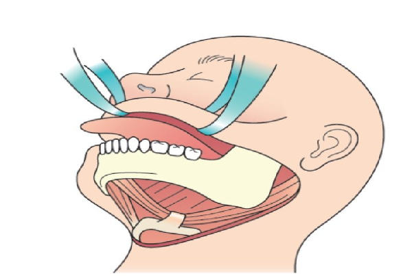 Commando operation  oral cancers