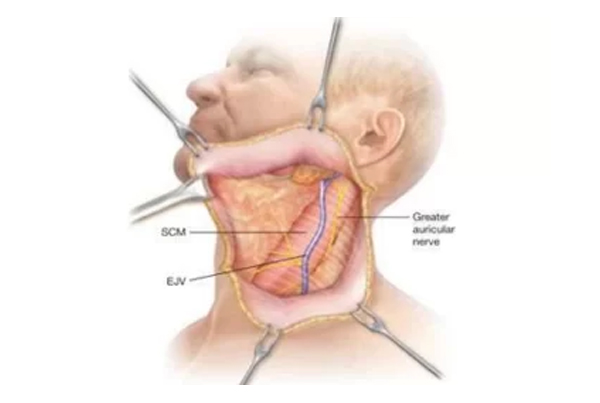 Neck Dissection