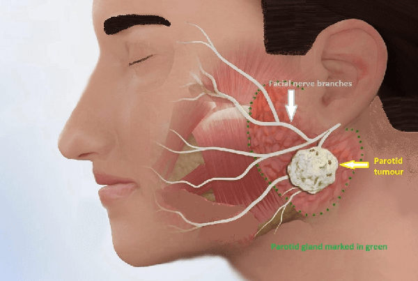 Salivary Gland Tumors  Parotid Surgery