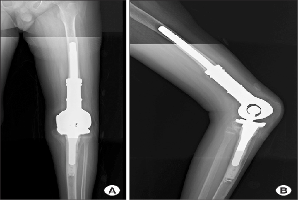 Limb Sparing  Reconstruction Surgery