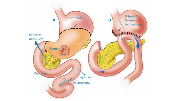 Gastrointestinal Cancer Surgery