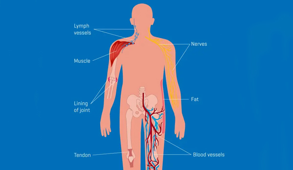 Bone & Soft Tissue Sarcomas