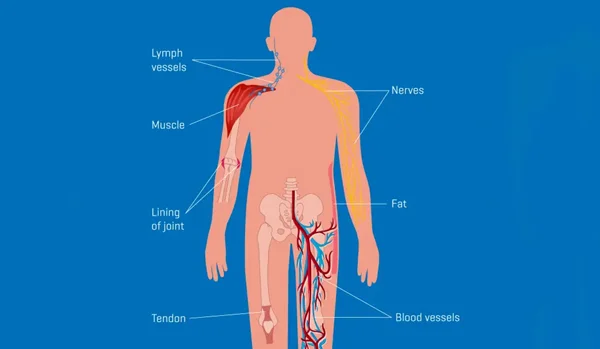Bone & Soft Tissue Sarcomas