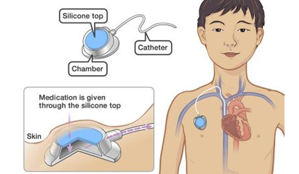 Chemoport Insertion