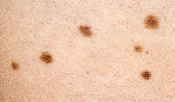 Skin Cancers