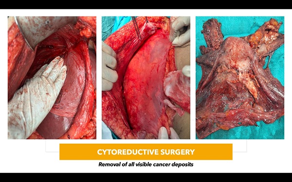 Cytoreductive Surgery