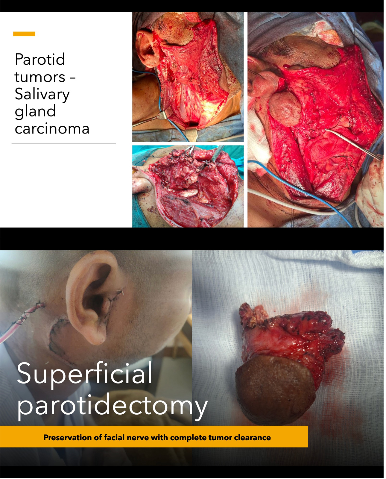 Parotid gland tumors Surgery