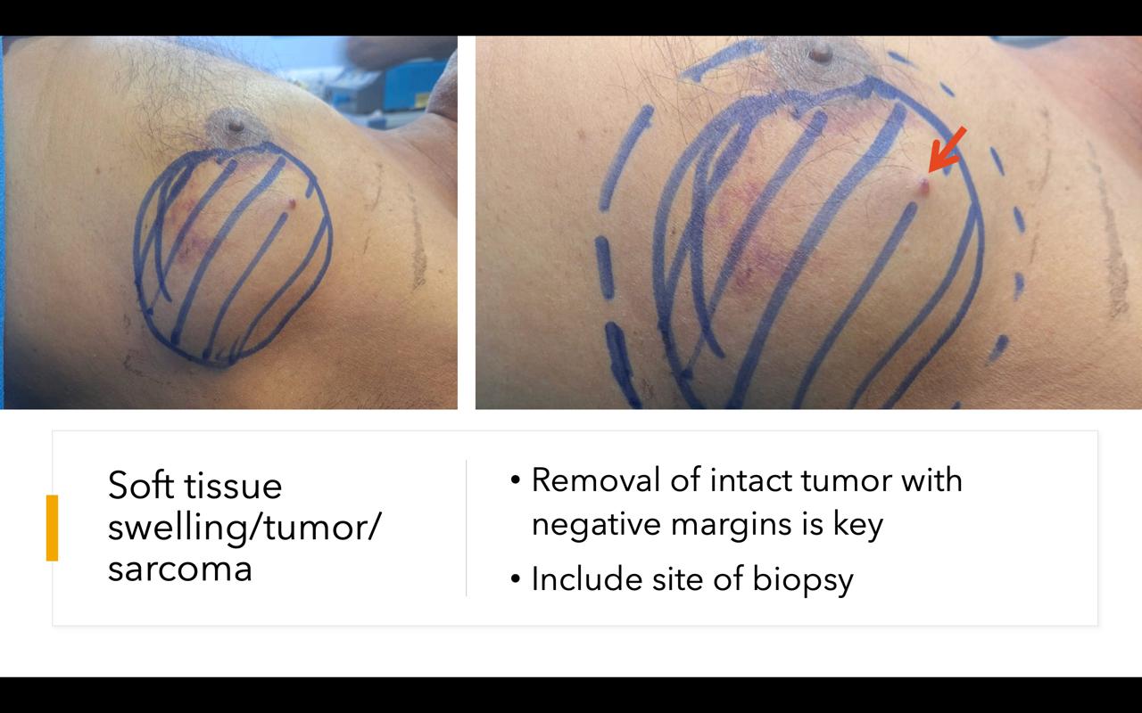 Soft Tissue Swelling Tumor Surgery