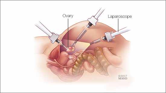 Ovarian Cancer Surgery